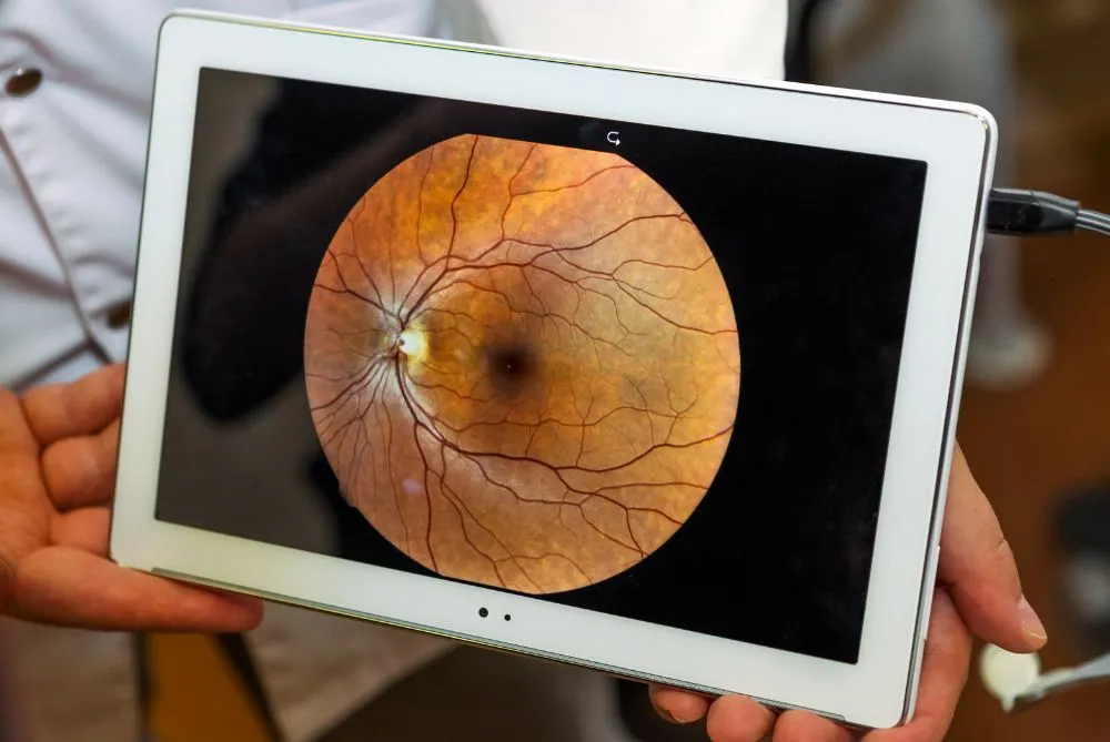 Exame de retinografia | COH